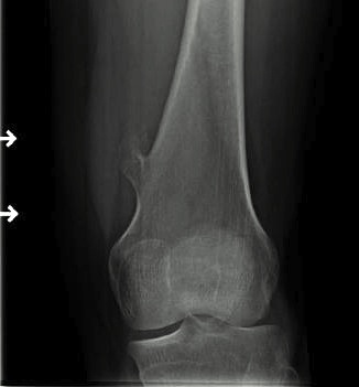 Femoral Osteochondroma